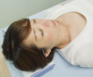 加古郡播磨町の美容鍼｜ノア鍼灸整骨院